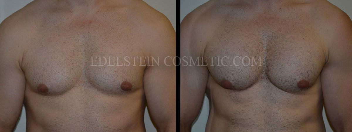 Pectoral-Implants-Toronto-Before-After-P01