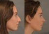 Primary Rhinoplasty case #26784 slider thumbnail