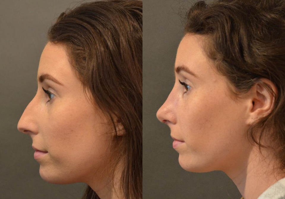 Primary Rhinoplasty case #26784