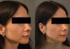 Primary Rhinoplasty case #26785 slider thumbnail