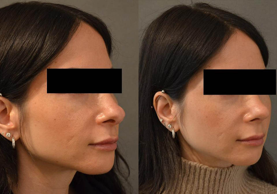 Primary Rhinoplasty case #26785