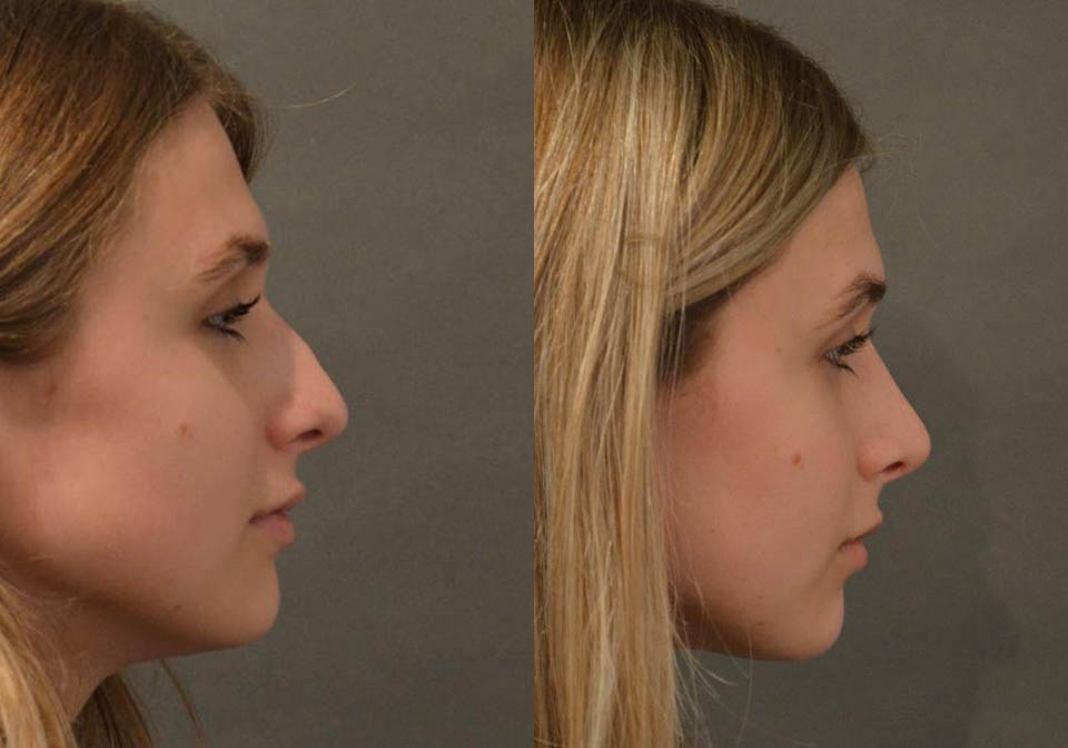 Primary Rhinoplasty case #26787