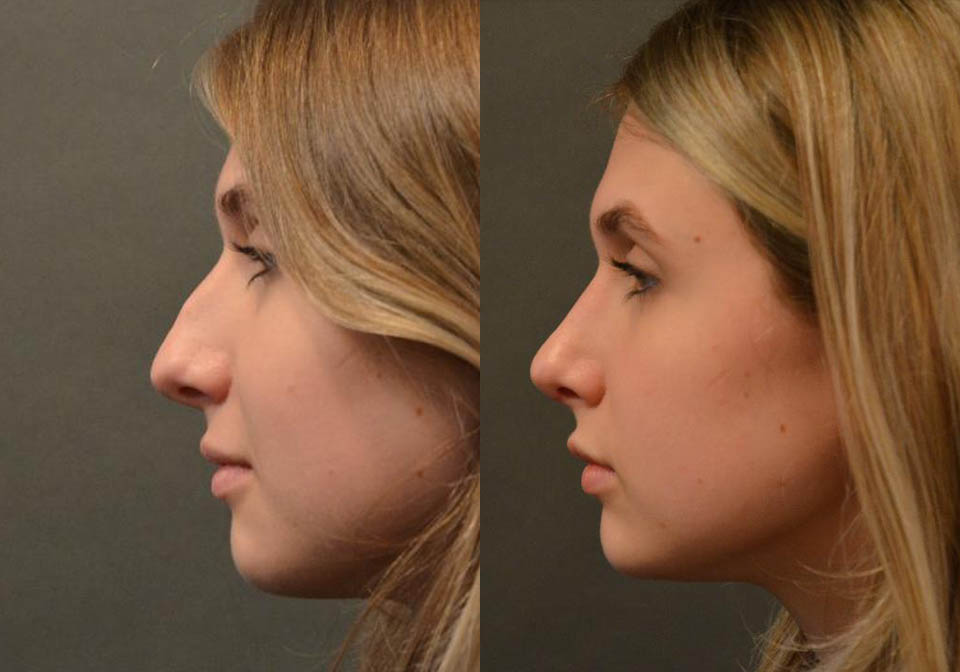 Primary Rhinoplasty case #26787