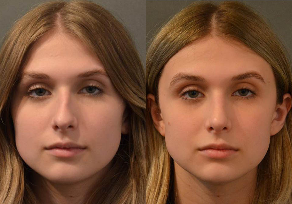 Primary Rhinoplasty case #26787