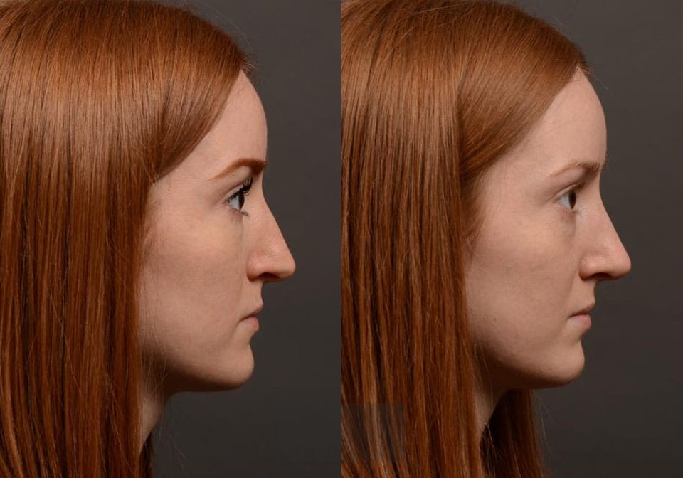 Primary Rhinoplasty case #26782