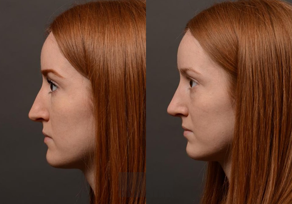 Primary Rhinoplasty case #26782