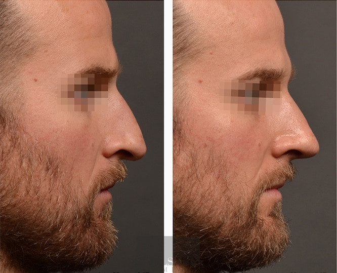 Primary Rhinoplasty case #26783