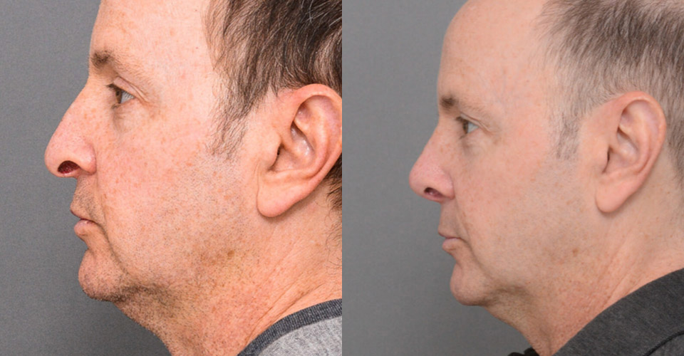 Primary Rhinoplasty case #26788