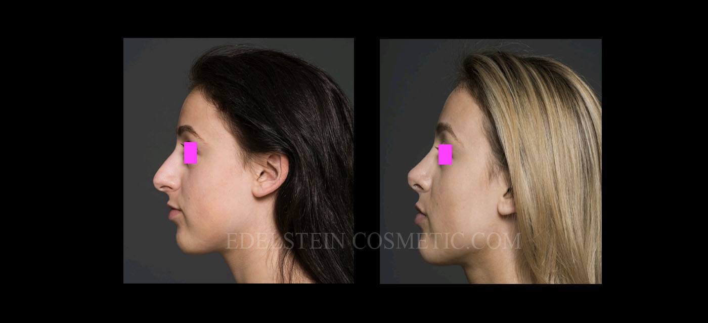 Primary Rhinoplasty case #26765