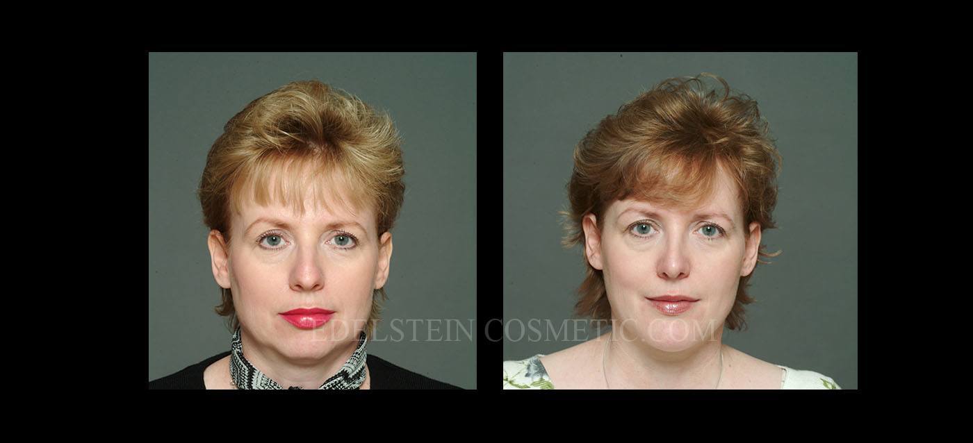 Primary Rhinoplasty case #26773