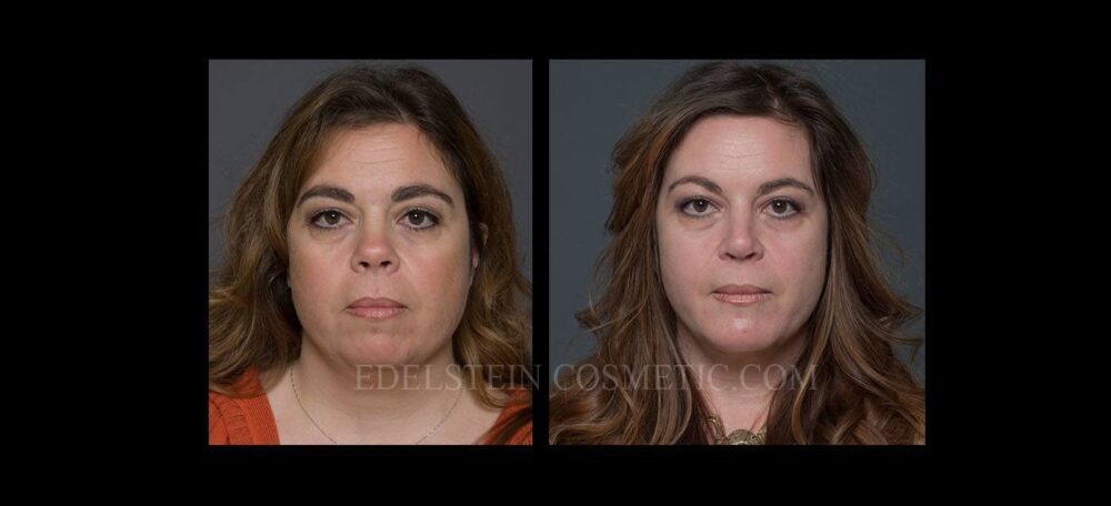 Primary Rhinoplasty case #26775