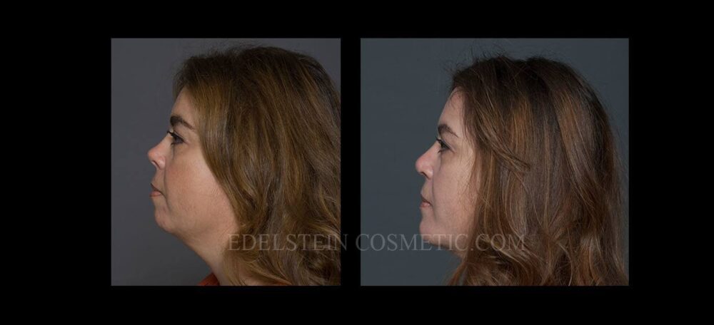 Primary Rhinoplasty case #26775