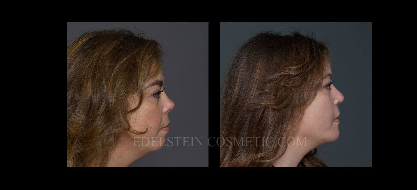 Primary Rhinoplasty case #26775