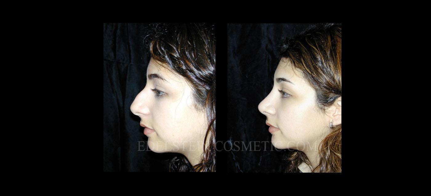 Primary Rhinoplasty case #26769