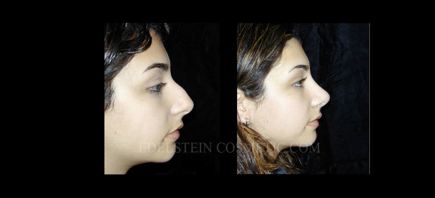 Primary Rhinoplasty case #26769