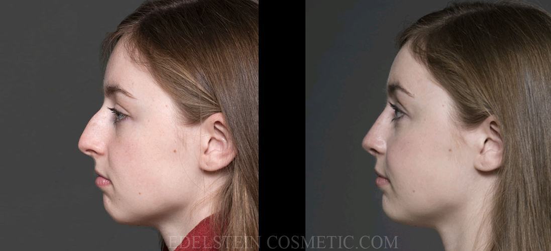 Primary Rhinoplasty case #26756