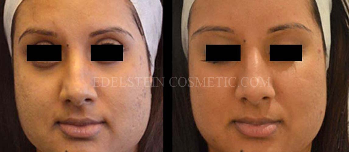 acne-scarring-removal-toronto-toronto-before-after-p01