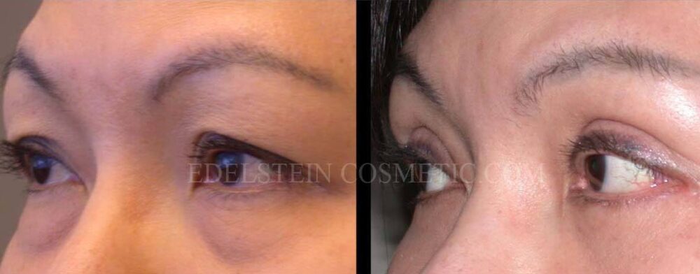 Blepharoplasty case #26808