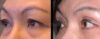 Blepharoplasty case #26808 slider thumbnail