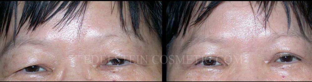 Blepharoplasty case #26810