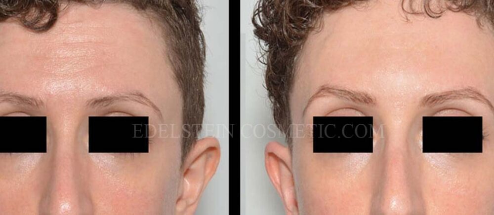 BOTOX® case #26560