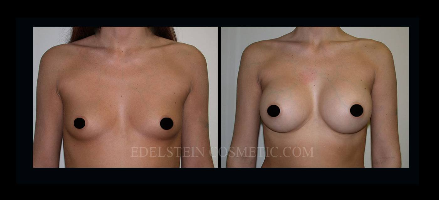 Breast Augmentation case #26866