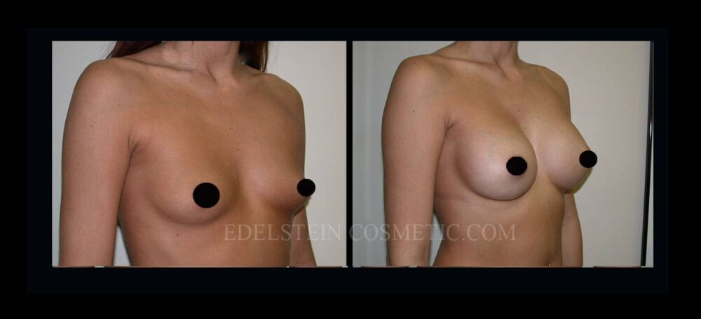 Breast Augmentation case #26866