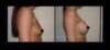 Breast Augmentation case #26866 slider thumbnail