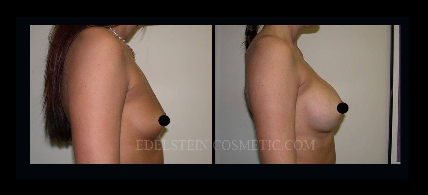 Breast Augmentation case #26866