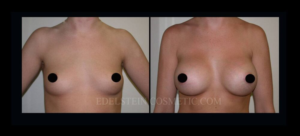 Breast Augmentation case #26865