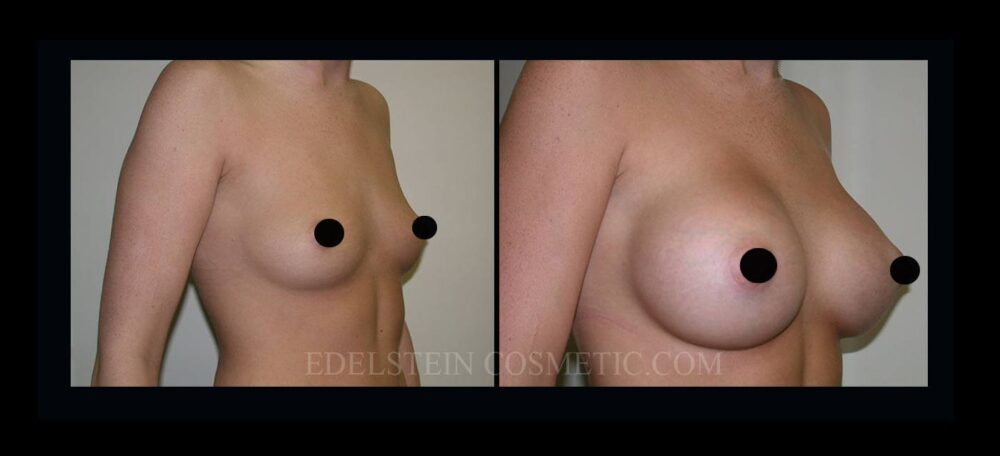 Breast Augmentation case #26865