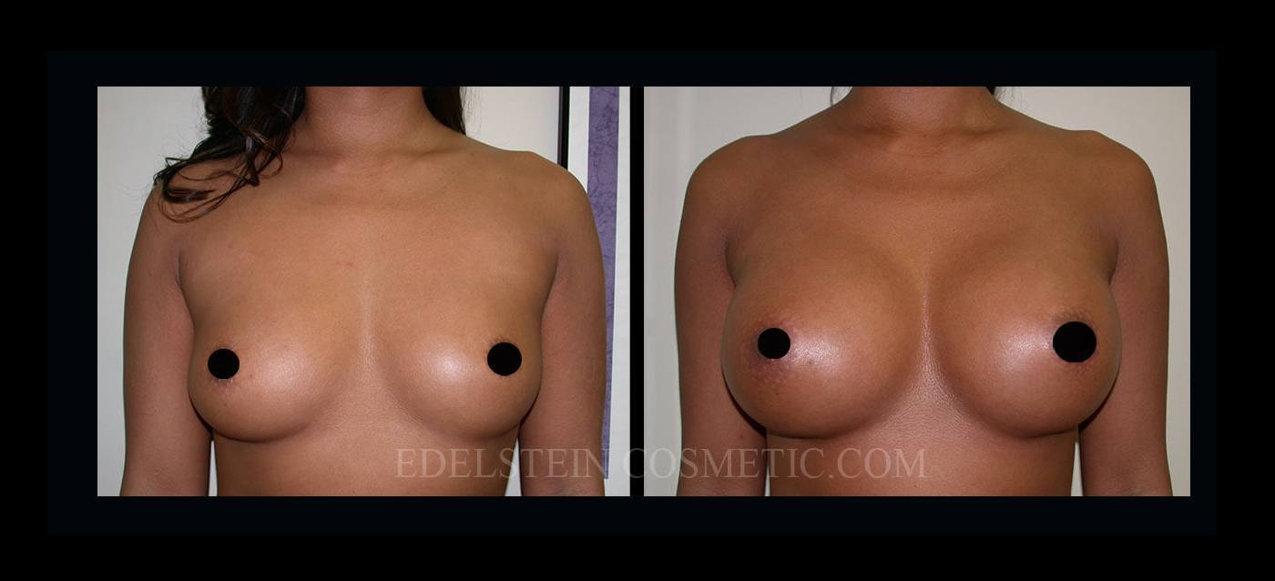 Breast Augmentation case #26864