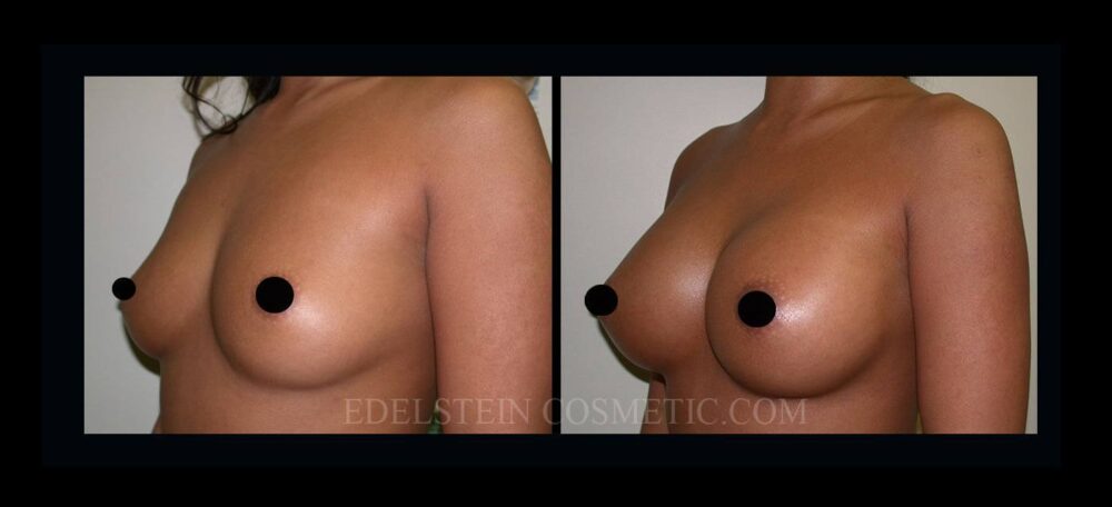 Breast Augmentation case #26864