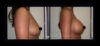 Breast Augmentation case #26864 slider thumbnail