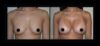 Breast Augmentation case #26863 slider thumbnail