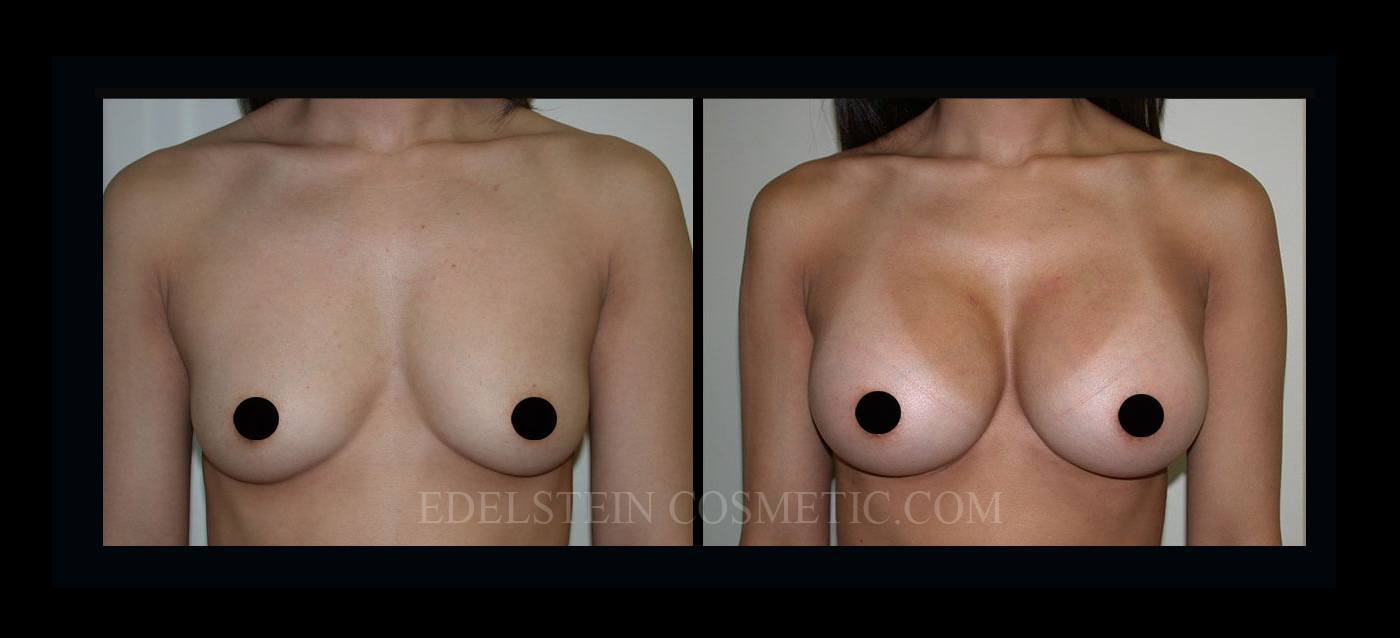 Breast Augmentation case #26863