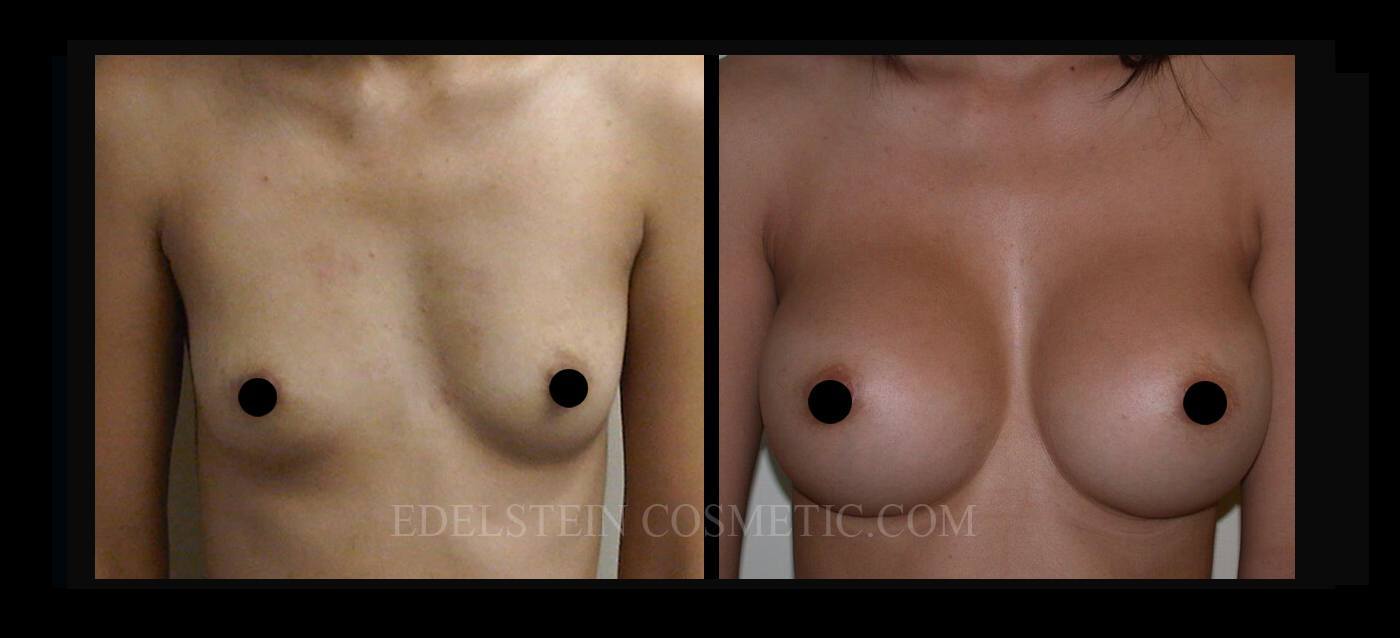 Breast Augmentation case #26689