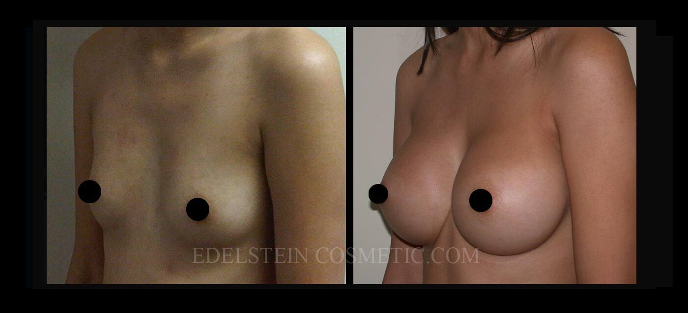 Breast Augmentation case #26689