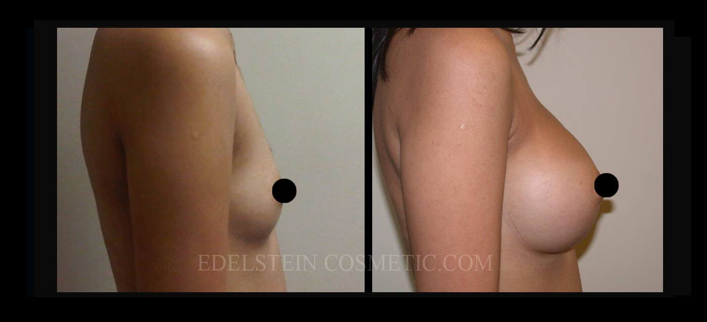 Breast Augmentation case #26689