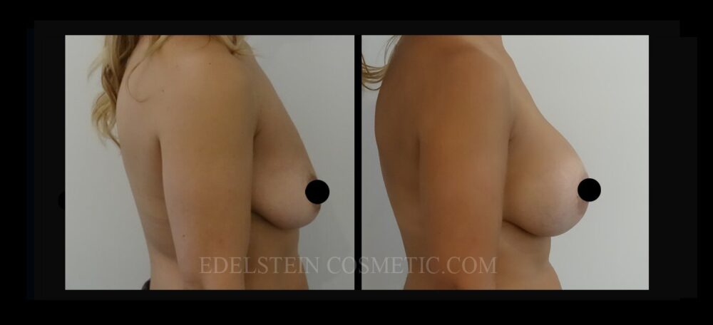 Breast Augmentation case #26686