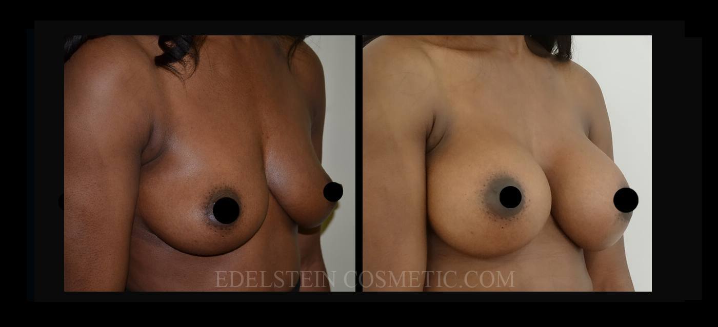 Breast Augmentation case #26685