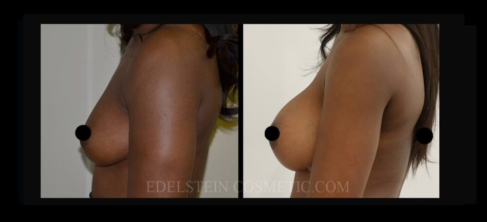 Breast Augmentation case #26685