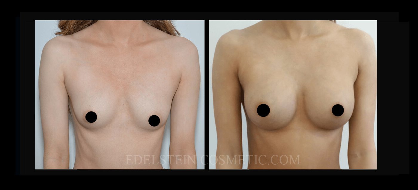 Breast Augmentation case #26682