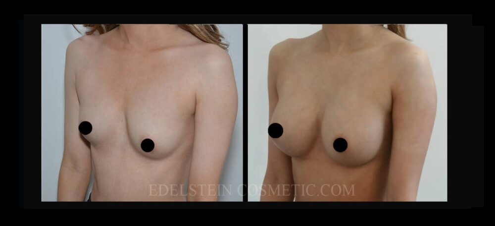 Breast Augmentation case #26682