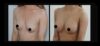 Breast Augmentation case #26682 slider thumbnail