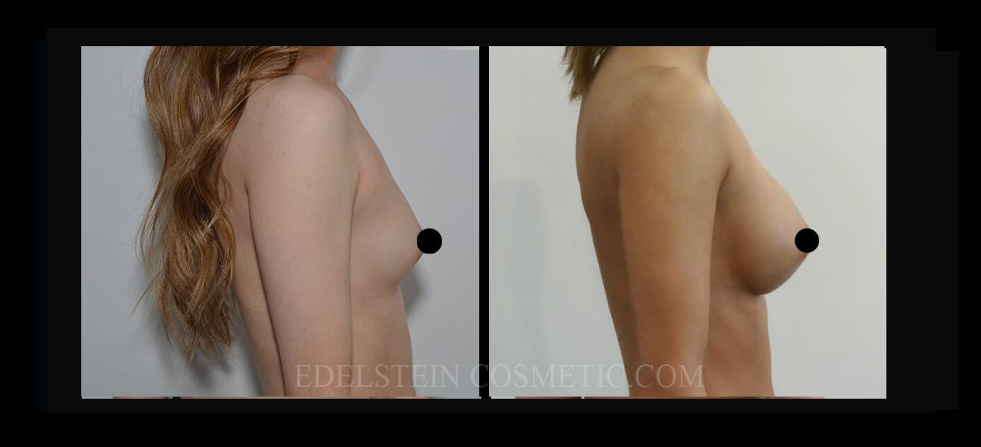 Breast Augmentation case #26682