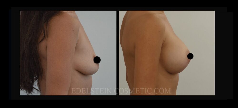 Breast Augmentation case #26677