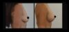 Breast Augmentation case #26677 slider thumbnail