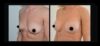 Breast Augmentation case #26667 slider thumbnail