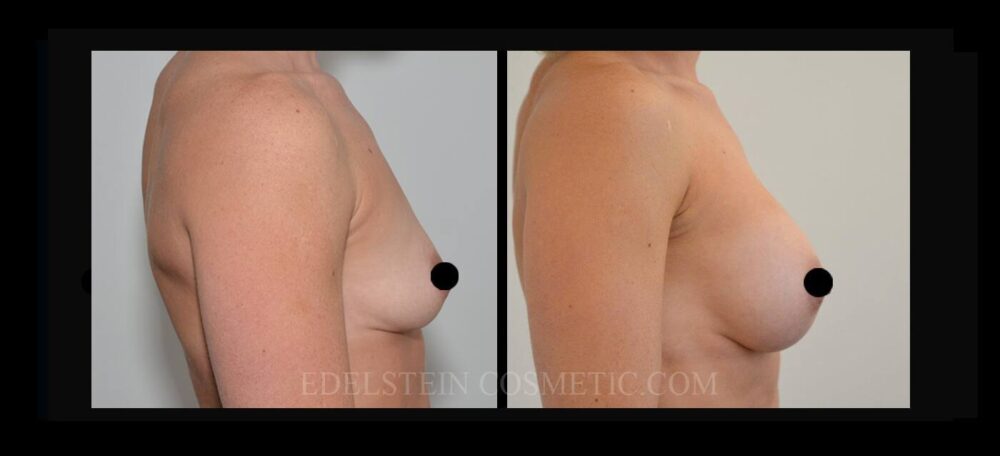 Breast Augmentation case #26667